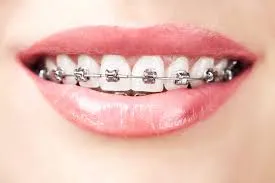 Braces