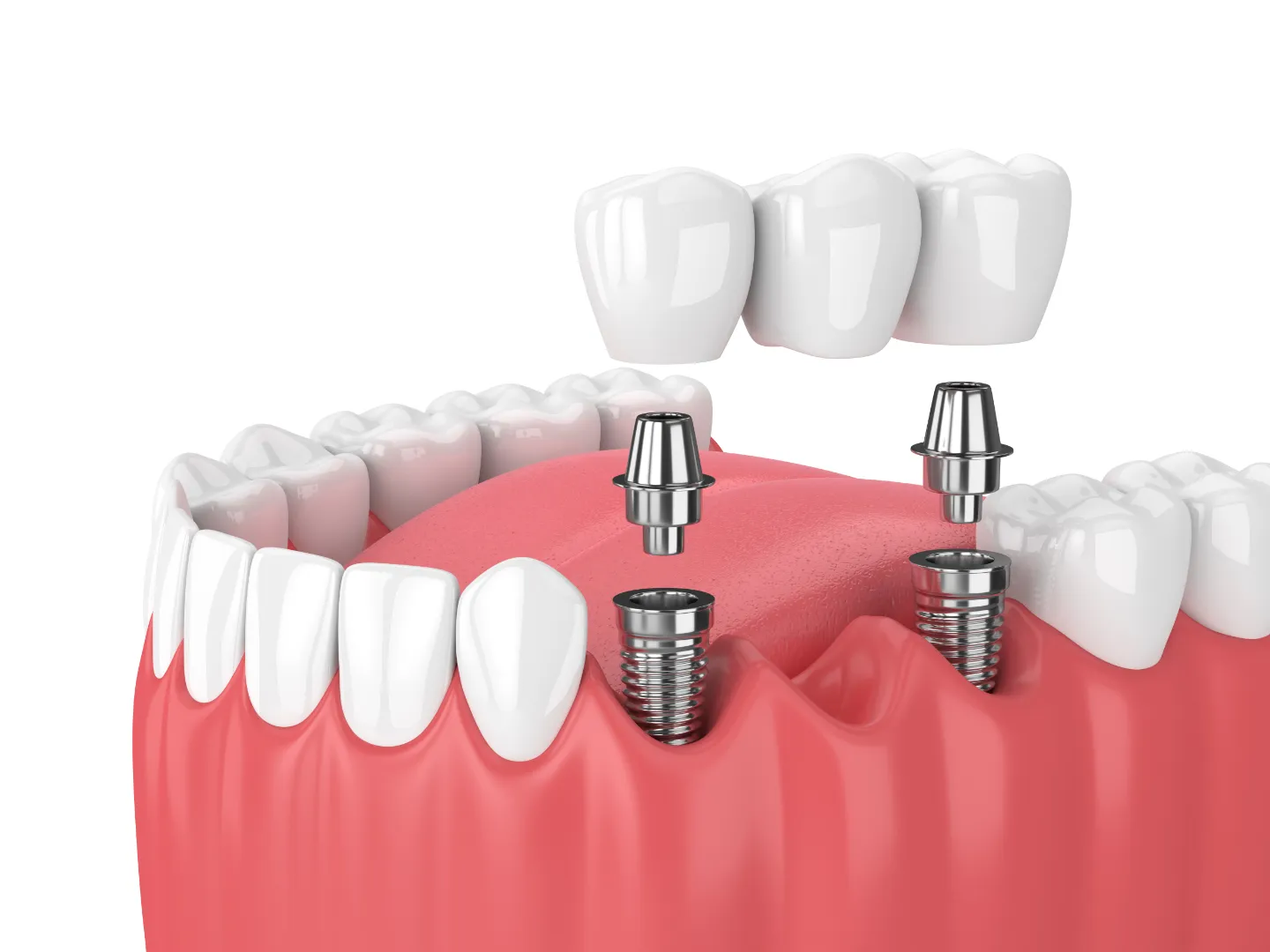 Implant Bridges