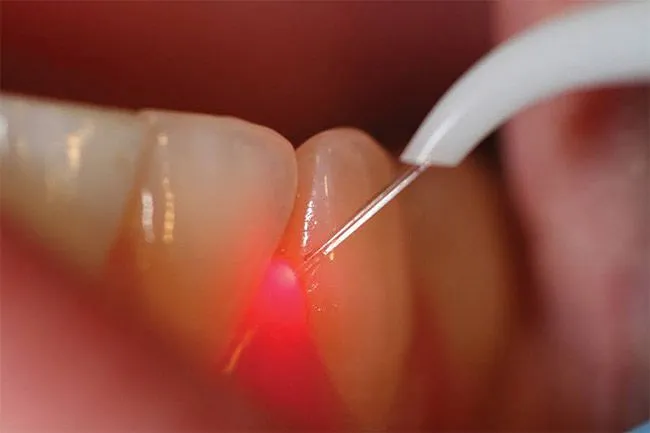 Laser Gum Surgeries